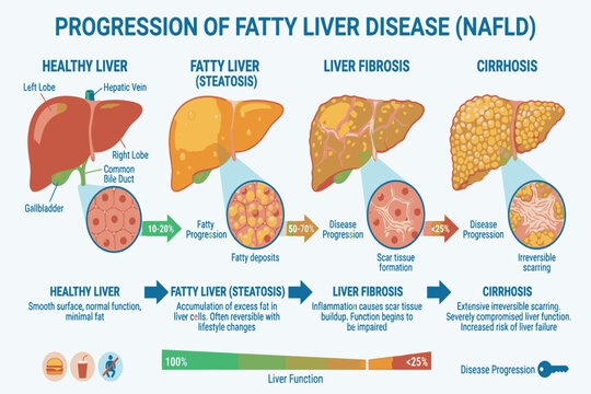 Educational infographic showing progressive fatty liver changes from simple steatosis through inflammation, fibrosis, and cirrhosis.