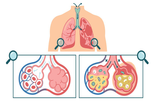 Professional healthcare infographic explaining pneumonia effects on alveolar health, emphasizing inflamed air sacs, fluid accumulation, impaired respiration, and oxygen exchange.