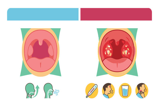 Educational medical infographic comparing normal and inflamed tonsils, illustrating swelling, redness, infection signs, white patches, and common symptoms.