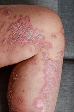 Close-up of inflamed dry scaly skin on a human leg, A chronic skin condition with redness, irritation, and flaky texture for healthcare and dermatology