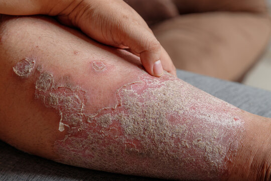 Close-up of inflamed dry scaly skin on a human leg, A chronic skin condition with redness, irritation, and flaky texture for healthcare and dermatology