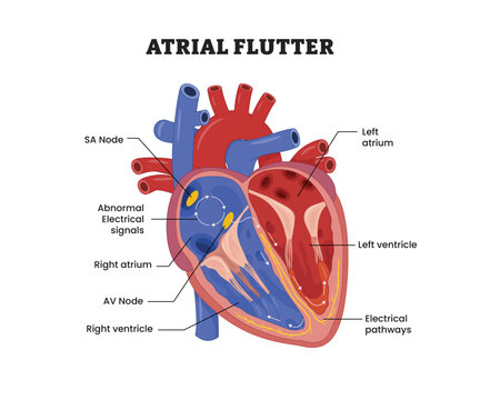 Atrial Flutter labeled diagram, educational medical poster design healthcare scheme, cardiac arrhythmia, abnormal rhythm. Labeled abnormal electrical signals SA node, AV node and electrical pathways