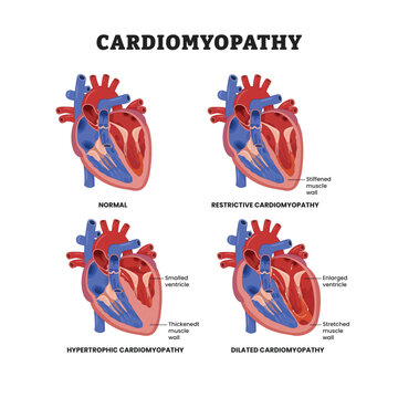 Cardiomyopathy types, heart muscle disease, educational medical poster design healthcare scheme, internal organs, cardiovascular disease, heart complication.Labeled restrictive, dilated, hypertrophic.