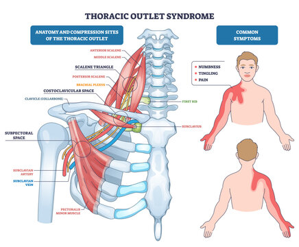 Thoracic outlet syndrome diagram shows compression of brachial plexus, subclavian artery and vein near the clavicle, mapping pain down the arm, transparent background