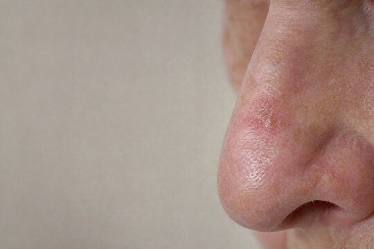 Early Actinic Keratosis on the Nose of an Elderly Patient