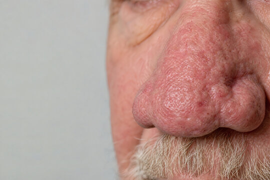 Rhinophyma With Enlarged Lobulated Nose and Thickened Pore-Rich Skin