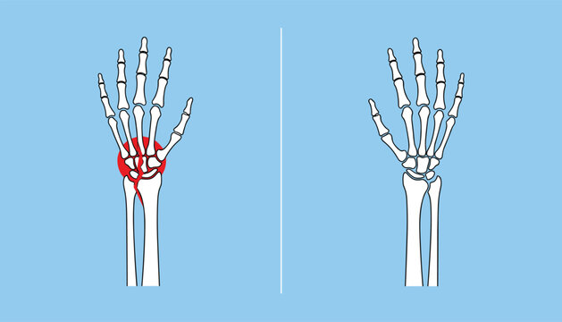 Comparison of fractured wrist and healthy hand skeleton bone structure in a medical diagnosis diagram vector.
