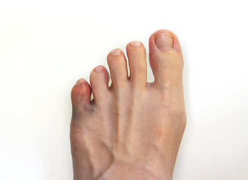 Human foot with bruised and swollen little toe isolated on white background
