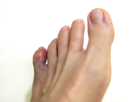 Human foot with bruised and swollen little toe isolated on white background
