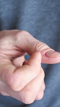 Man's hand showing a bloody cut on his thumb, a painful injury from a kitchen knife accident. The close up reveals the fresh wound near the fingernail, highlighting the need for first aid