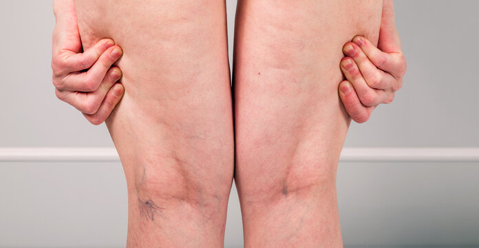 Woman squeezing back of knees showing varicose veins spider veins and vascular leg problem