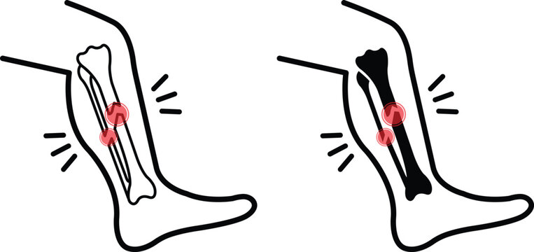 Bone fracture and leg injury icons set for medical and healthcare design. Collection of lower leg bone fracture symbols highlighting broken tibia and fibula. Vector illustration