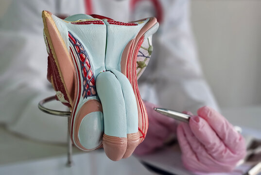 Doctors counseling patients with prostate cancer and using a penis model to show patients with prostate cancer