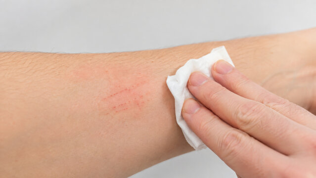 Shallow Scratch Marks on Adult Forearm During First Aid Care