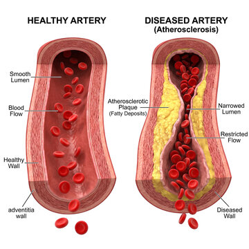 Diagram comparing healthy and diseased atherosclerotic arteries.