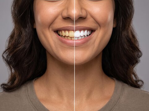 Before and after comparison of teeth whitening on a smiling young woman, showing the stark contrast between yellow stained teeth and a bright white healthy smile for dental care and cosmetic dentistry