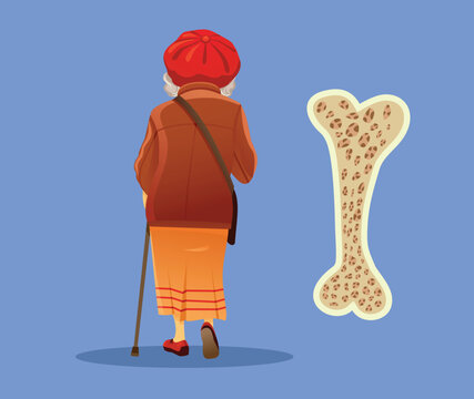 Osteoporosis Risk Factor In Aging Elderly Senior Populations Condition Concept. Illustration showcasing osteoporosis disease with a fragile bone pattern beside an older woman 