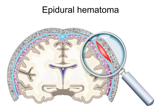 Epidural hematoma anatomy, magnified cross-sectional view of bleeding between skull and dura mater, medical illustration