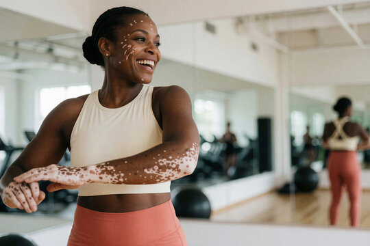Woman with vitiligo stretching her arm in a gym