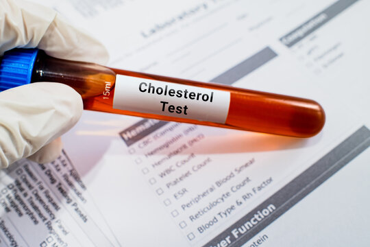 blood sample in lab test tube for Cholesterol test