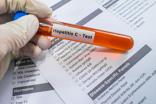 blood sample in lab test tube for Hepatitis C test