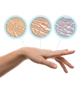 Skin Aging Collagen Loss Wrinkled Skin, medical illustration showing progressive changes in skin texture and collagen structure on the human hand