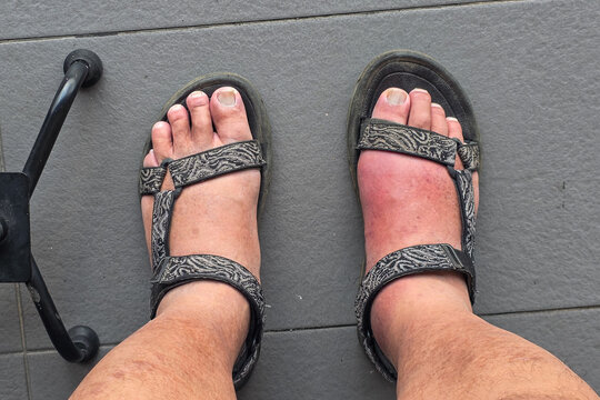 Man with swollen inflamed painful right foot due to acute gout attack