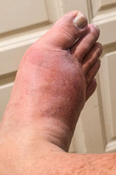 Close-up of real swollen inflamed painful right foot due to acute gout attack
