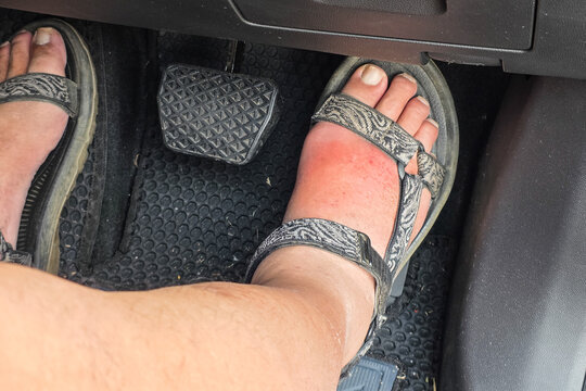 Man with gout inflamed, swollen and painful right foot attempting to step onto car pedal to drive car.