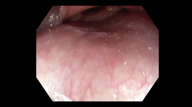 Gastroscope Insertion Through Oral Cavity and Pharynx