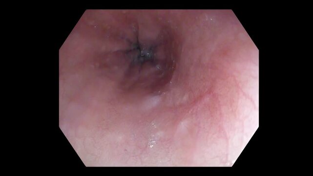 Radial Esophageal Mucosal Folds Around Central Lumen During Endoscopy