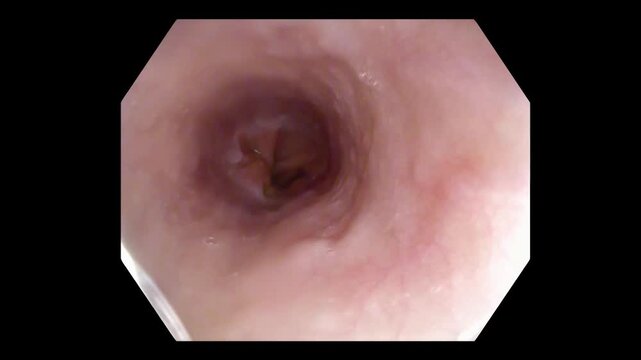 Endoscopic Passage Through Esophageal Lumen During Gastroscopy