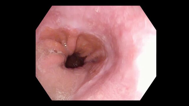 Esophageal Lumen During Gastroscope Withdrawal in Full HD
