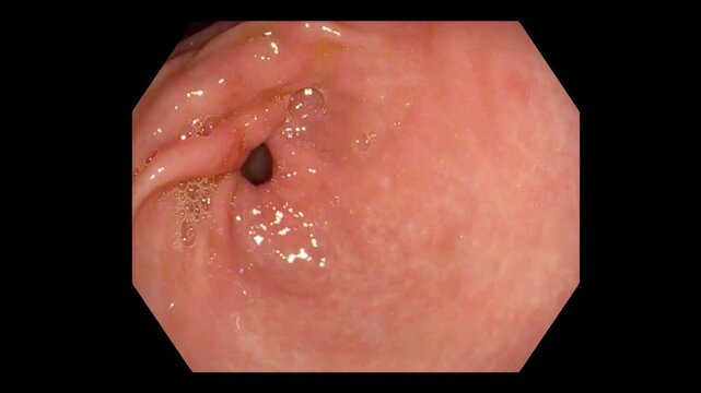 Pyloric Opening Seen During Upper Gastrointestinal Endoscopy