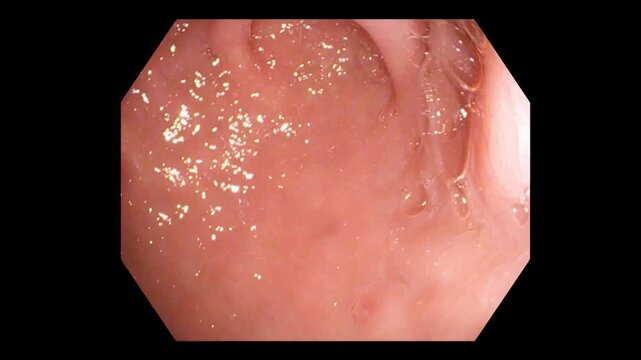 Gastric Mucosa and Stomach Folds During Full HD Gastroscopy