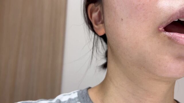 口角炎に悩む女性