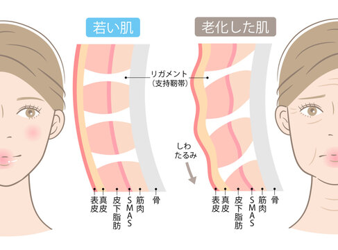 支持靭帯のしくみ　老化でたるんだ女性とと若い女性の顔
