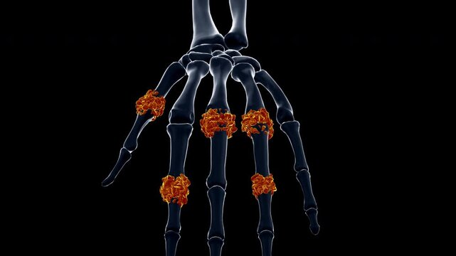 Medical dynamic video materials on bone and joint diseases