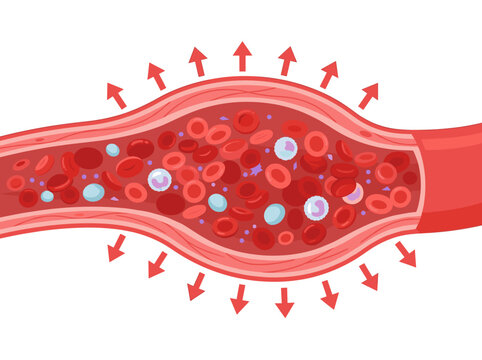 Medical illustration of high blood pressure and vasodilation in a blood vessel