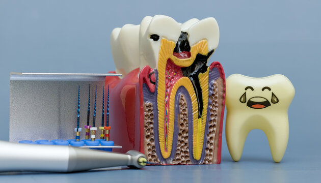 Toothache and dental fear concept. Crying sad tooth toy next to anatomical model showing deep decay and endodontic root canal instruments.