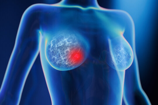 3D medical illustration of a transparent female body highlighting breast tissue with a red glowing tumor, representing early breast cancer detection, mammography, and oncology research.