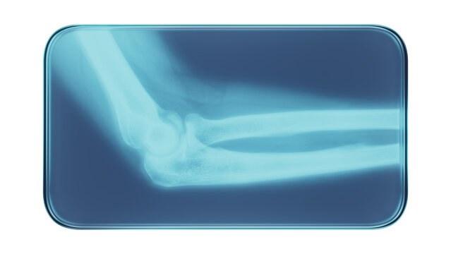 Glass Frame with X-Ray Human Elbow Medical Illustration