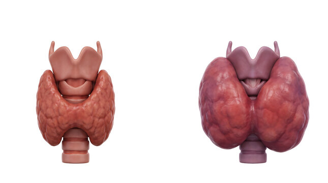 3D render of normal thyroid gland compared to enlarged goiter showcasing medical comparison on an isolated background