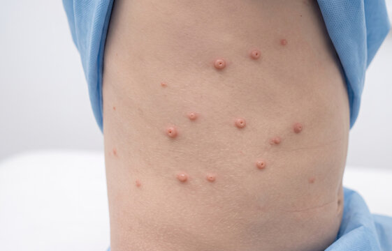 Close-up of a child's torso covered in umbilicated papules and blisters, typical of a viral infection like molluscum contagiosum or chickenpox.
