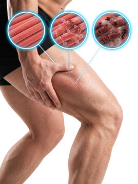 Muscle injury and muscle damage concept, knee pain and damaged skeletal muscle tissue anatomy for sports medicine physical therapy and healthcare