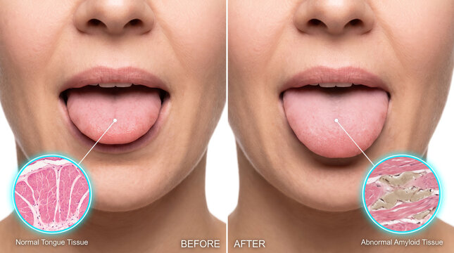 Tongue tie correction before and after, tongue frenulum treatment comparison showing improved tongue mobility and oral health