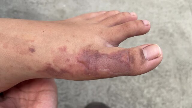 Severe second degree burn wound on top foot area (instep), visible bullae on the surface