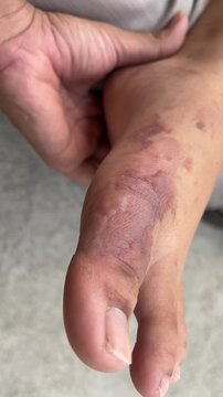 Severe second degree burn wound on top foot area (instep), visible bullae on the surface
