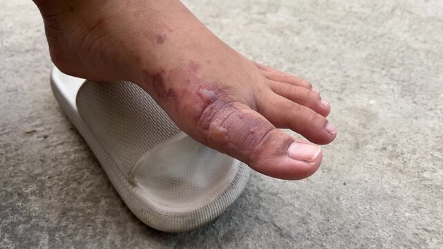 Severe second degree burn wound on top foot area (instep), visible bullae on the surface