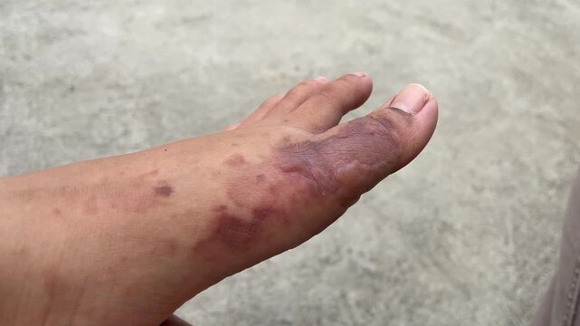 Severe second degree burn wound on top foot area (instep), visible bullae on the surface